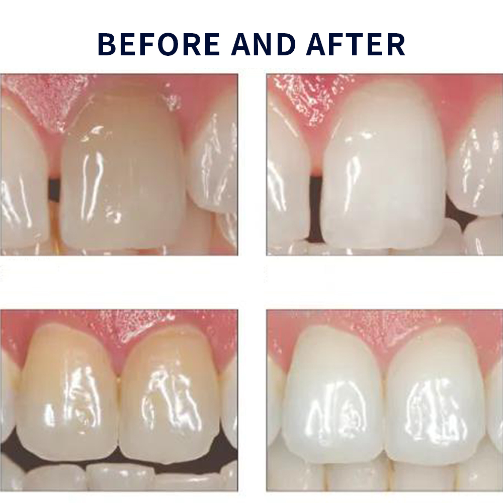 Opalescence Whitening 20% PF 2 - Teeth Whitening Gel recension och pris