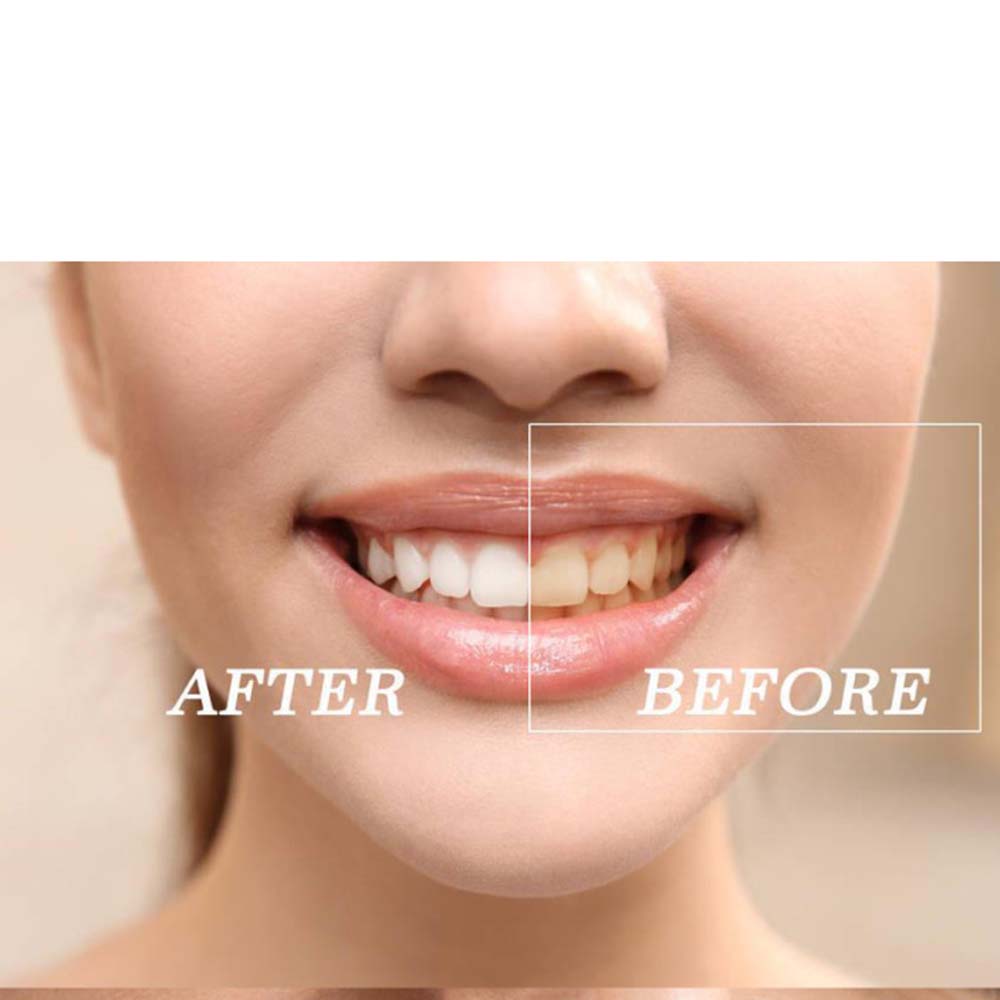 Top Quality Peroxide Teeth Whi - Teeth Whitening Gel recension och pris