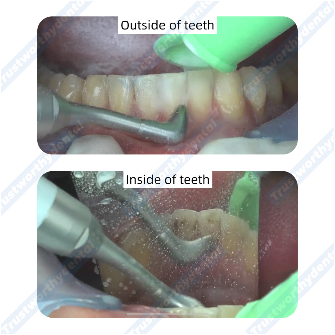 Dental Air Polisher Oral Autoc - Colgate Whitening Teeth recension och pris