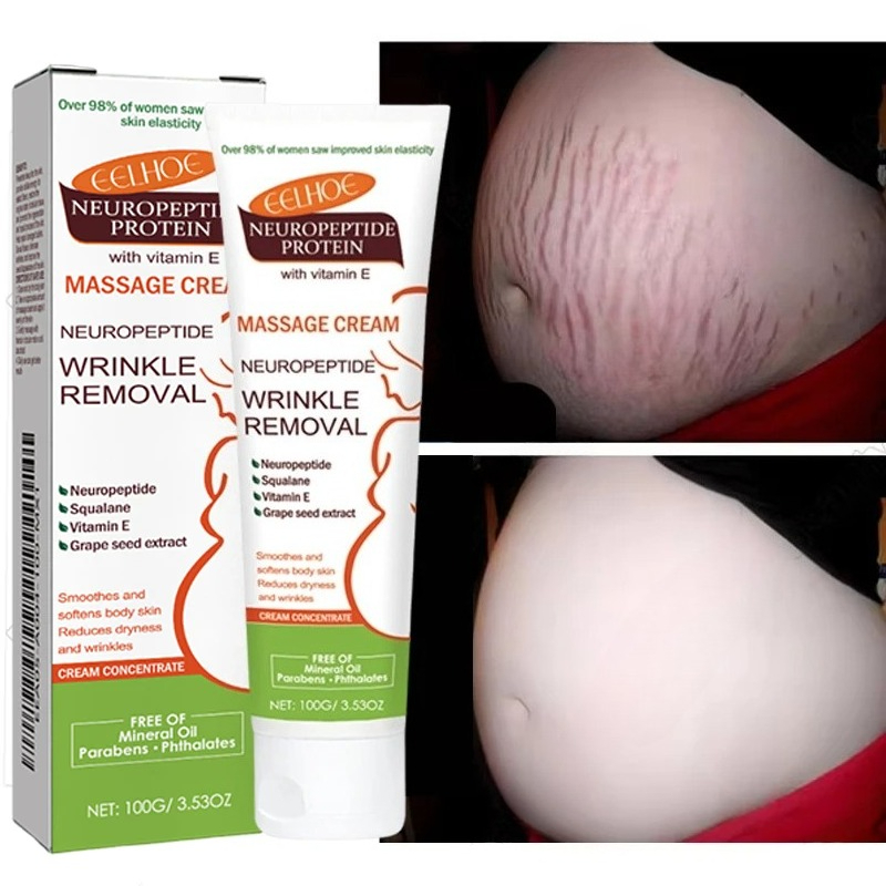 100g Stretch Marks Permanent R - Teeth Whitening Pregnancy recension och pris